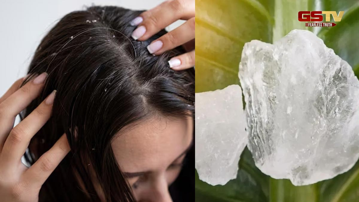 Hair Care / ડેન્ડ્રફથી છુટકારો મેળવવામાં મદદરૂપ થઈ શકે છે ફટકડી, આ રીતે કરો તેનો ઉપયોગ