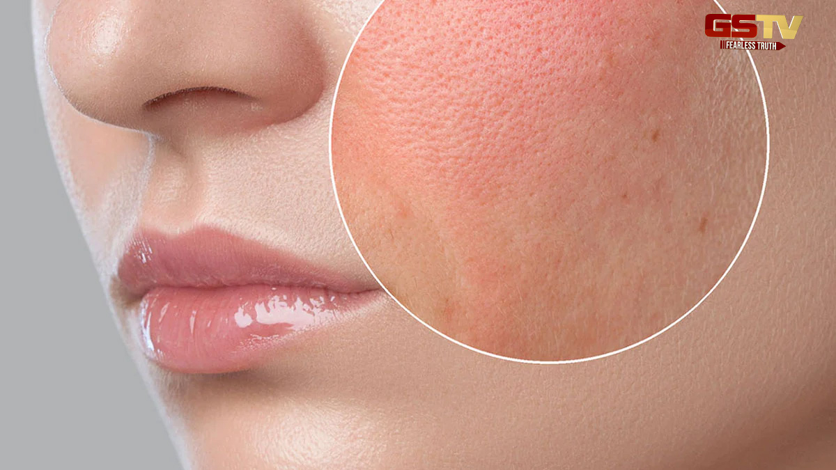 Dry Skin: ત્વચા ડ્રાય છે તો ઉનાળાની ઋતુમાં આ વાતનું રાખો ધ્યાન