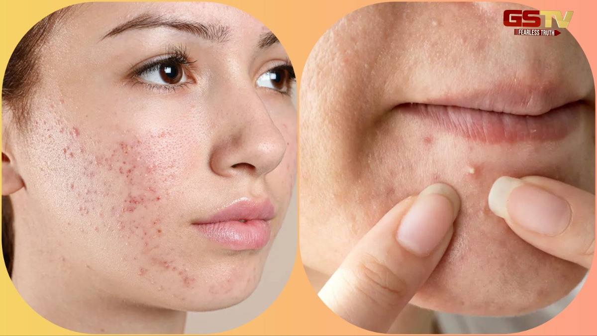 Skin Care: ચહેરા પર વારંવાર ખીલ થાય છે, તો માત્ર એક નહીં, છ કારણો છે જવાબદાર!