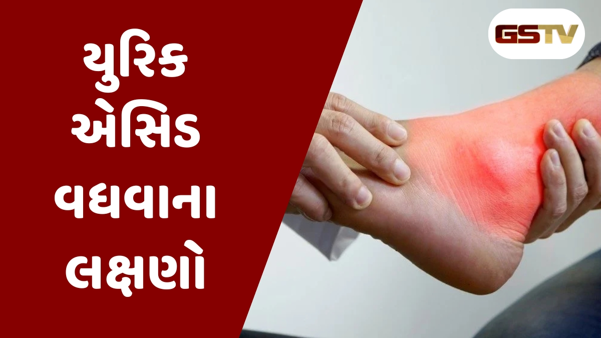 Health Tips: યુરિક એસિડ ઘટાડવા માટે આજથી જ શરૂ કરો આ 6 કામ, થશે બમણો લાભ