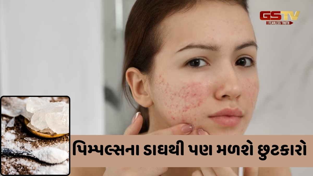 Beauty Tips / રાત્રે ચહેરા પર લગાવો આ વસ્તુ, દૂર થશે પિમ્પલ્સ, તમને મળશે ચમકતી ત્વચા