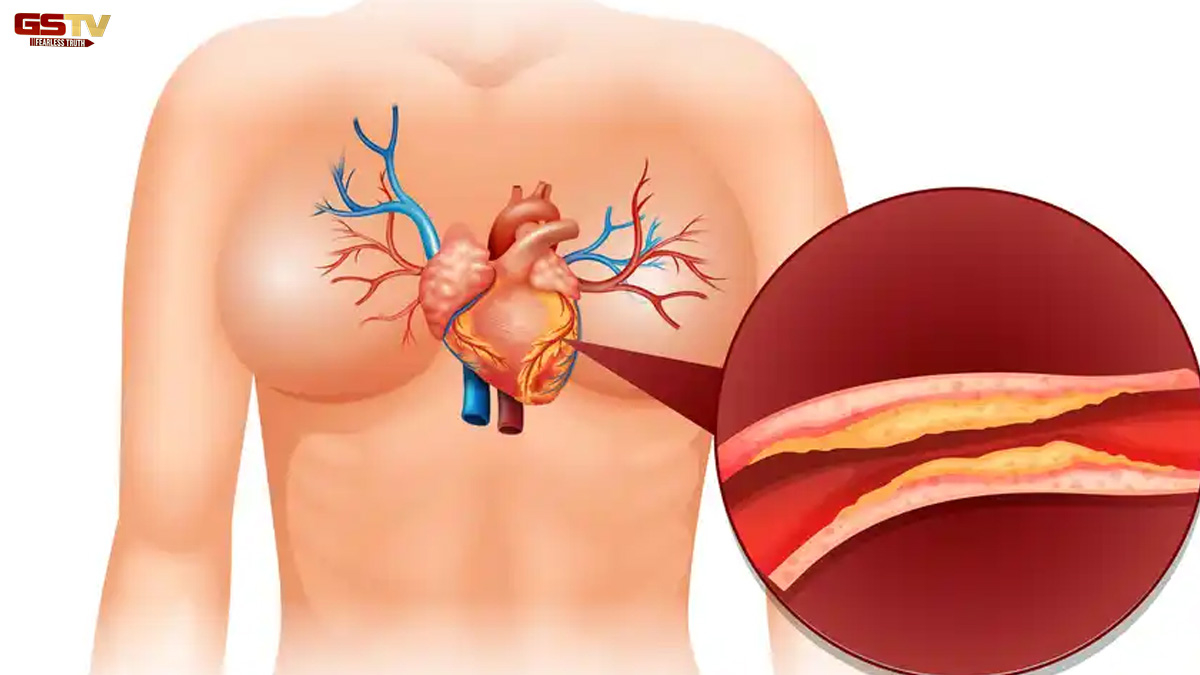 Health Tips : બમણી ઝડપે કોલેસ્ટ્રોલ વધારે છે આ 6 ફૂડ,  હાર્ટ એટેકનું વધશે જોખમ!
