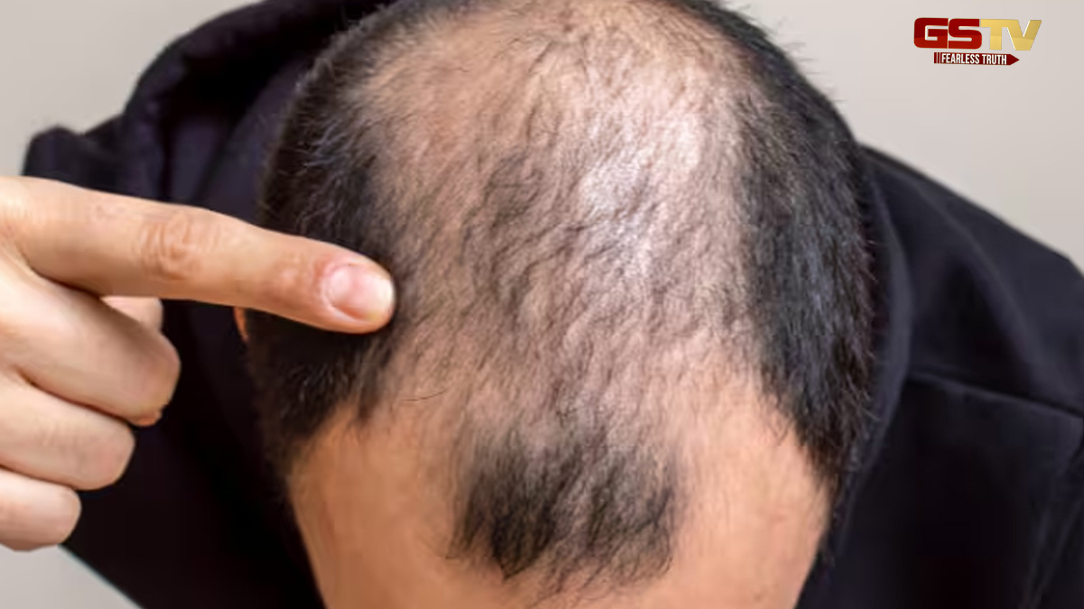 Hair Care Tips : ભારતીય પુરુષોમાં ઝડપથી 'ટાલિયા' થવાની સમસ્યા વધી! અપનાવો આ ઉપાય