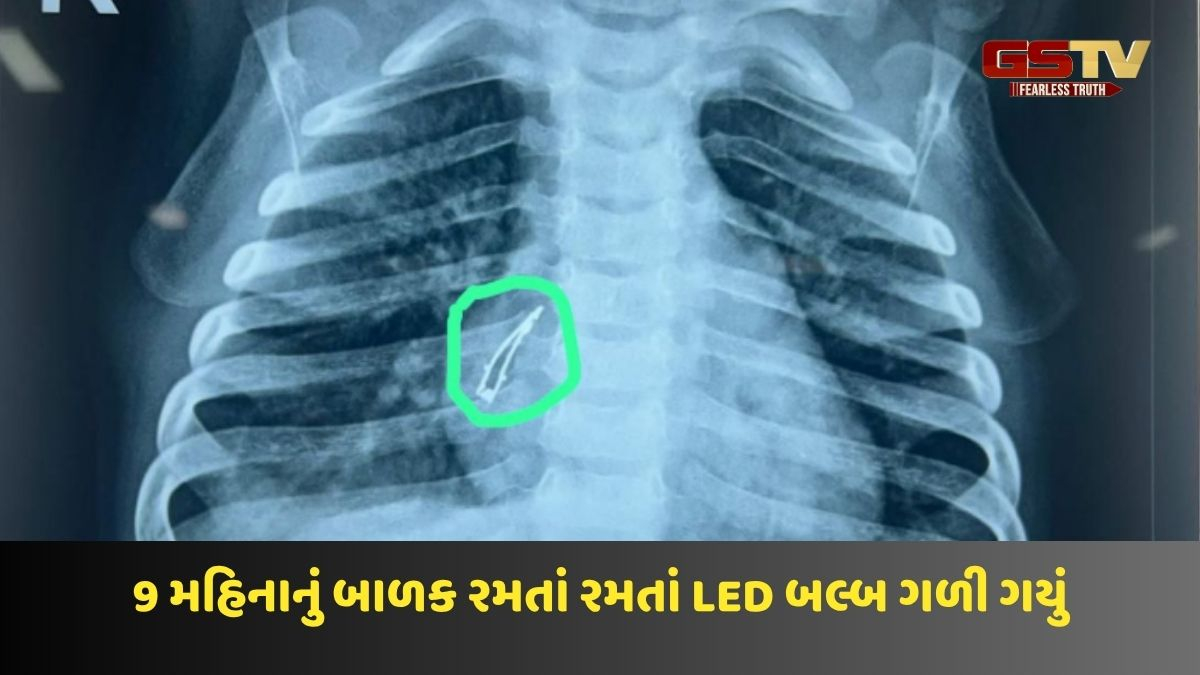 Junagadh news: 9 મહિનાનું બાળક રમતાં રમતાં મોબાઈલનો LED બલ્બ ગળી ગયું, અમદાવાદ સિવિલના ડોક્ટરોએ સર્જરી કરી માસૂમનો બચાવ્યો જીવ