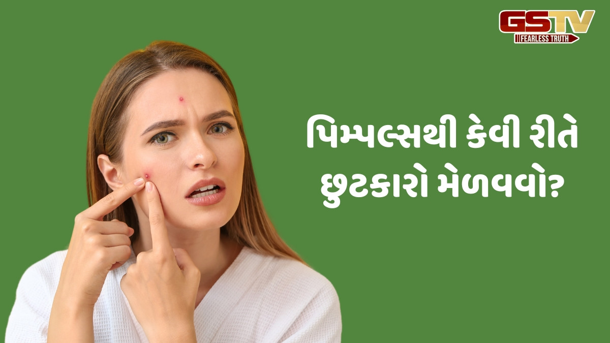 Beauty Tips / પિમ્પલ્સ થઈ ગયા હોય તો સ્કિન કેરમાં ન કરો આ ભૂલો, નહીં તો વધી જશે સમસ્યા