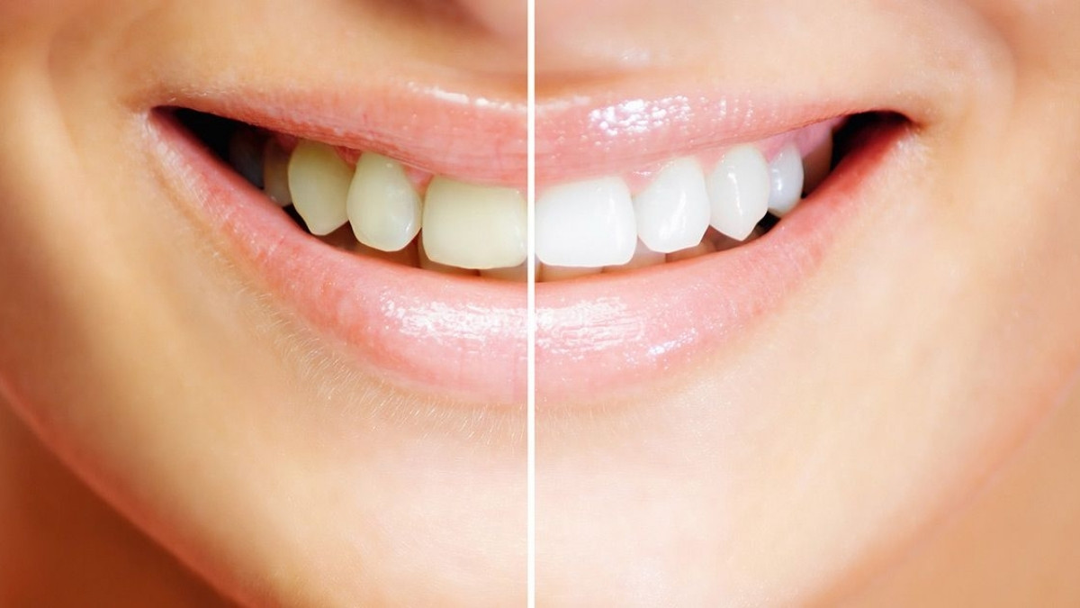 Beauty Tips : દાંત મોતીની જેમ ચમકશે, ફક્ત ટૂથપેસ્ટમાં ભેળવીને લગાવો આ એક વસ્તુ