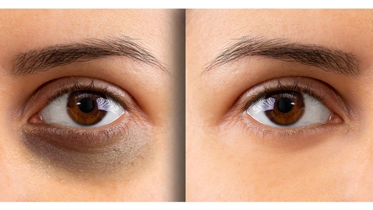 Beauty Tips : આ 3 ફળો આંખ નીચેના ડાર્ક સર્કલ કરશે દૂર, વિટામિન E અને Cથી છે ભરપૂર 