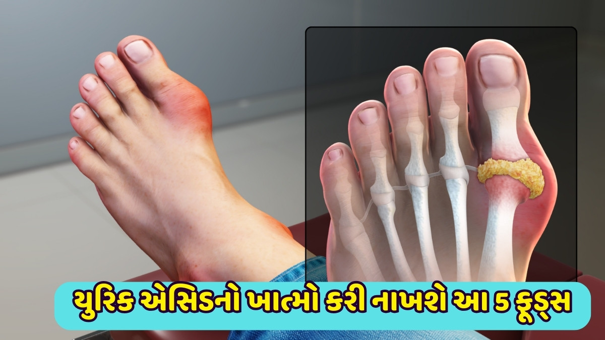 Health Tips : યુરિક એસિડનો ખાત્મો કરી નાખશે આ 5 ફૂડ્સ, તરત દેખાશે અસર 