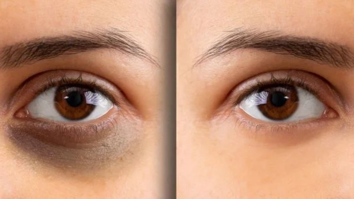 Beauty Tips  : આ કુટેવોના લીધે જ થાય છે આંખો નીચે ડાર્ક સર્કલ, જાણો કાળા કુંડાળા દૂર કરવાના સરળ ઉપાય