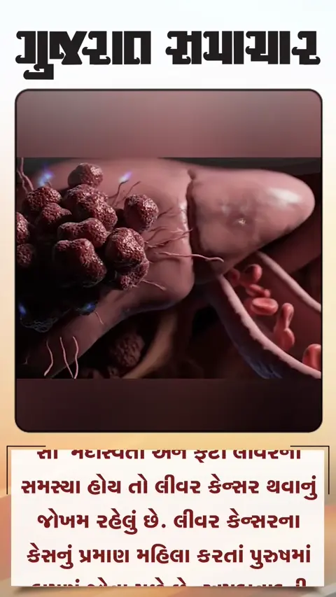 દારૂ, મેદસ્વિતા, હિપેટાઇટિસથી  લીવર કેન્સરનું જોખમ