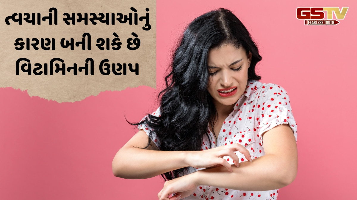 Beauty Tips / શિયાળામાં આ વિટામિનની ઉણપથી શુષ્ક થઈ શકે છે ત્વચા, ડ્રાય સ્કિનથી છુટકારો મેળવવા ફોલો કરો ટિપ્સ
