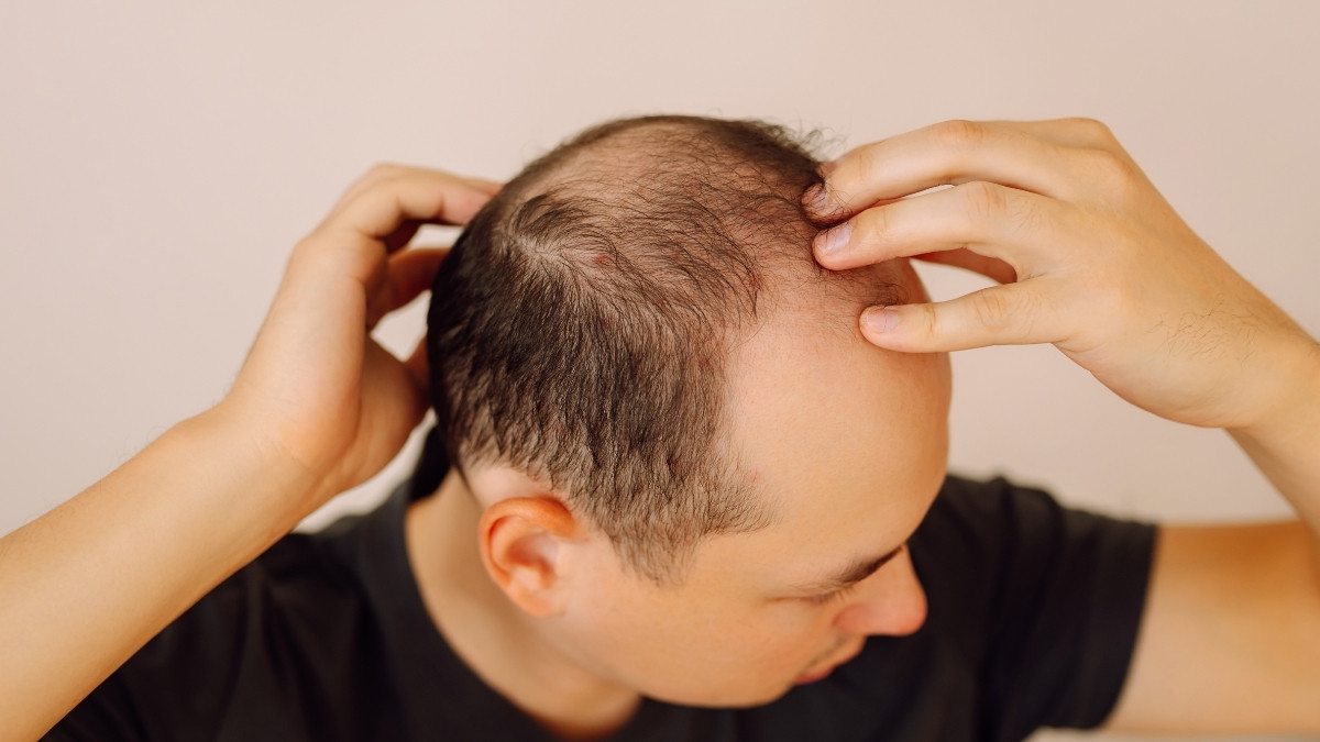 Hair Care : નાની ઉંમરમાં જ યુવાનોને કેમ ટાલ પડી રહી છે? ડોક્ટરનો ચોકાવનારો ખુલાસો
