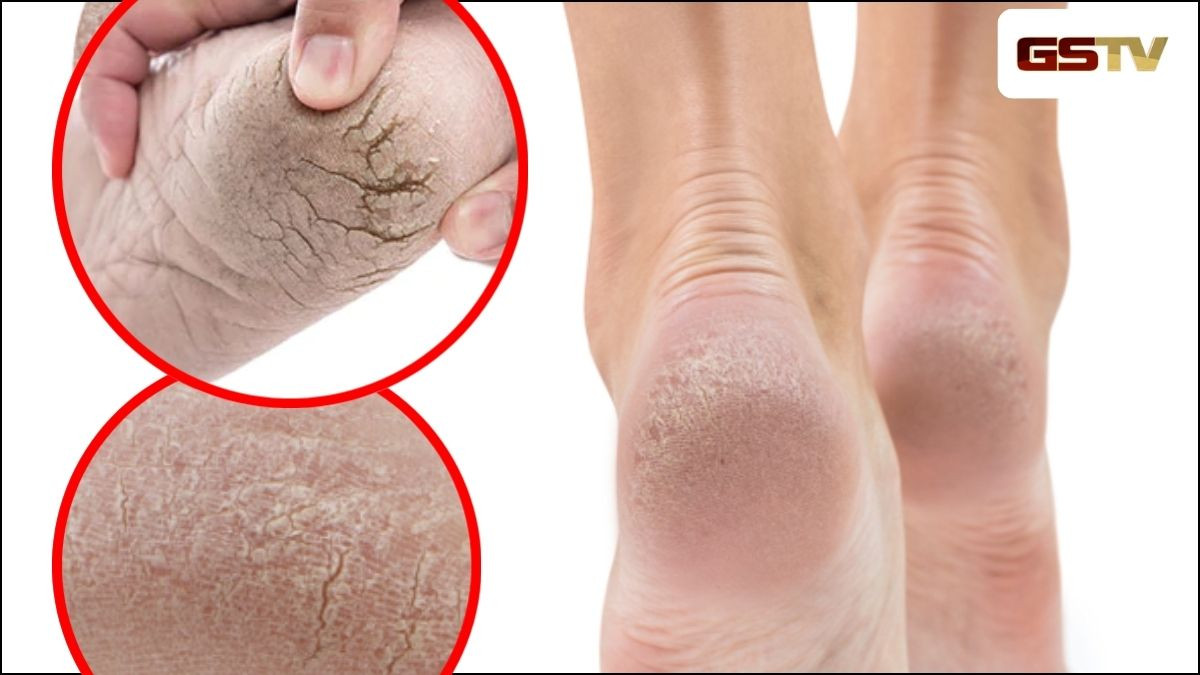 Beauty tips : શું શિયાળામાં તમારા પગની એડી જ ફાટી જાય છે? આ ઉપાય લેગને બનાવશે ખૂબ જ નરમ!