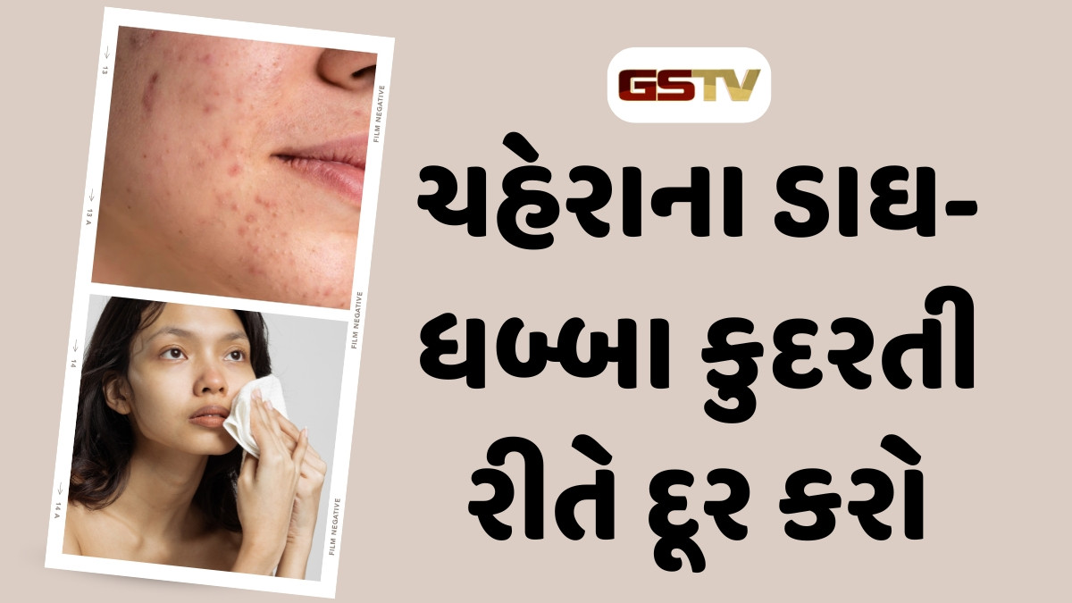 Beauty tips : ખીલ અને ડાઘથી ચહેરાની સુંદરતા છીનવાઈ ગઈ, તો ઘરેલુ ઉપાયથી મેળવો ગ્લોઈંગ સ્કિન