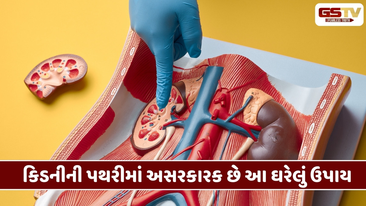 Health Tips : કિડનીની પથરીમાં અસરકારક છે આ ઘરેલું ઉપાય, ગંભીર સમસ્યામાં આપશે તરત રાહત