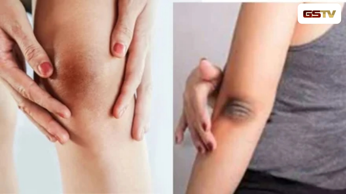 Skin care: કોણી, ઘૂંટણ અને ગરદન પરની કાળાશ દૂર કરવા લગાવો આ વસ્તુ, ત્વચા થઈ જશે સુંદર