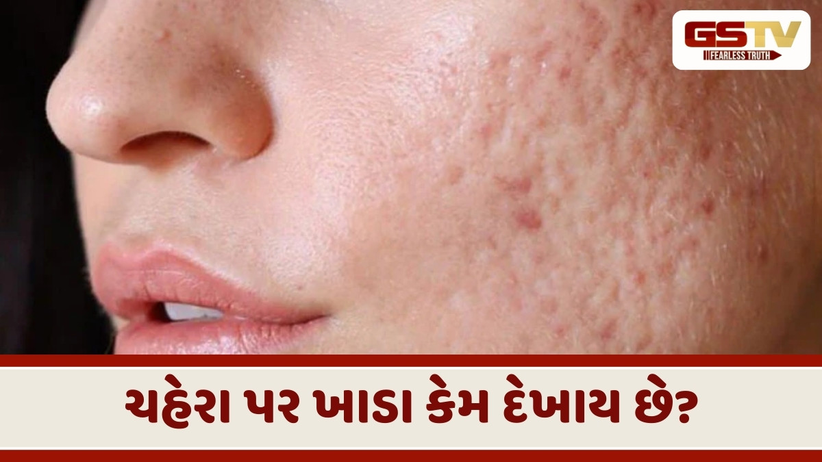 Skin Care Tips: ખીલના કારણે થયેલા ખાડાને આ રીતે કરો દૂર, જાણો ઘરેલુ ઉપાય