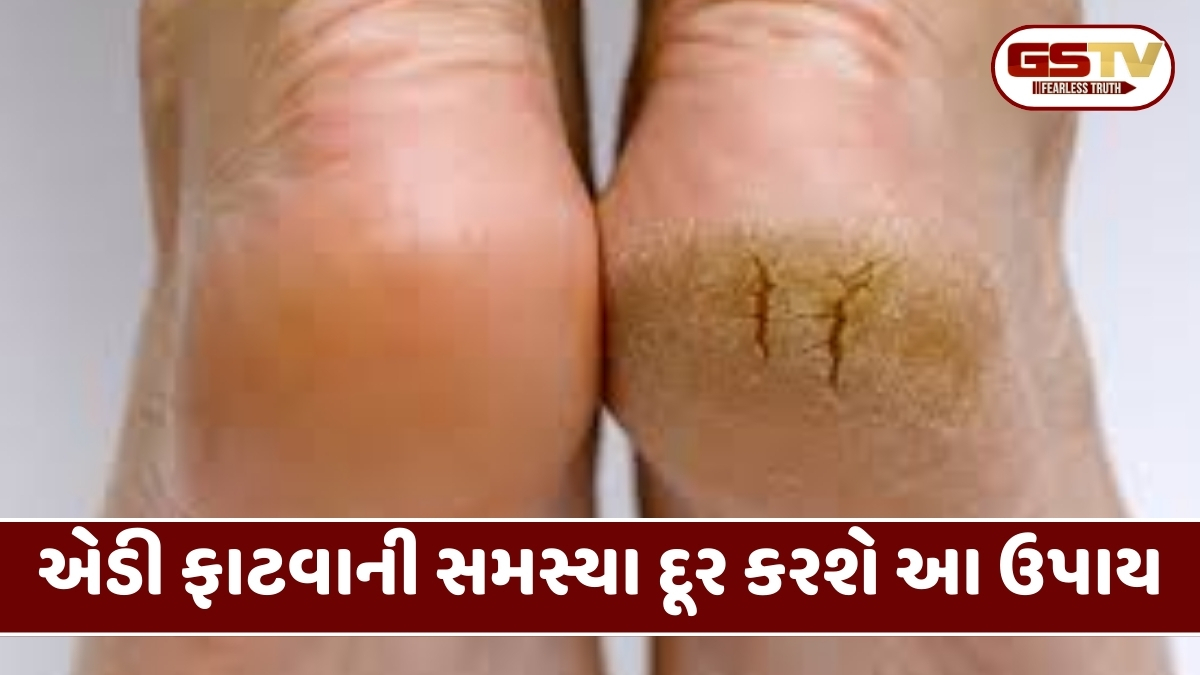 શિયાળામાં એડી ફાટવાની સમસ્યાથી પરેશાન છો? તો જરૂર અપનાવો આ નુસખા