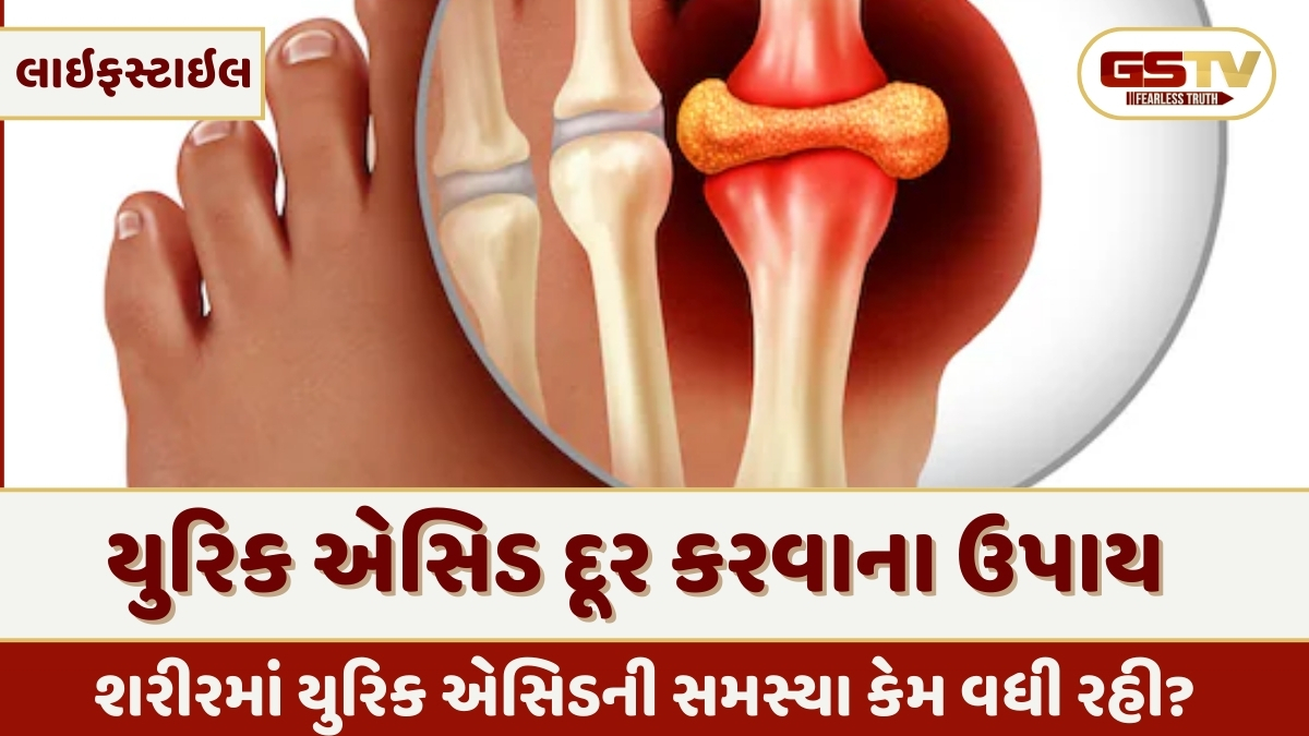 Health Tips : શું તમને યુરિક એસિડની તકલીફ છે? તો જાણો તેને મટાડવાના સરળ ઉપાય