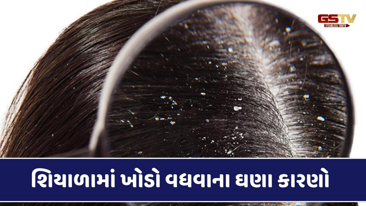 Hair Care Tips : શિયાળામાં વાળમાં ખોડાની સમસ્યાથી પરેશાન હોય તો આ ઉપાયથી મેળવો છુટકારો