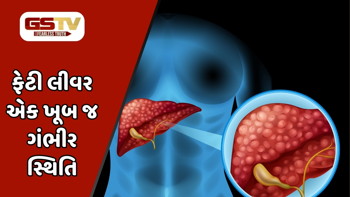 Health Tips :  આ 3 પીણાં પીવા ફેટી લીવરથી જડમૂળમાંથી આપશે છુટકારો 