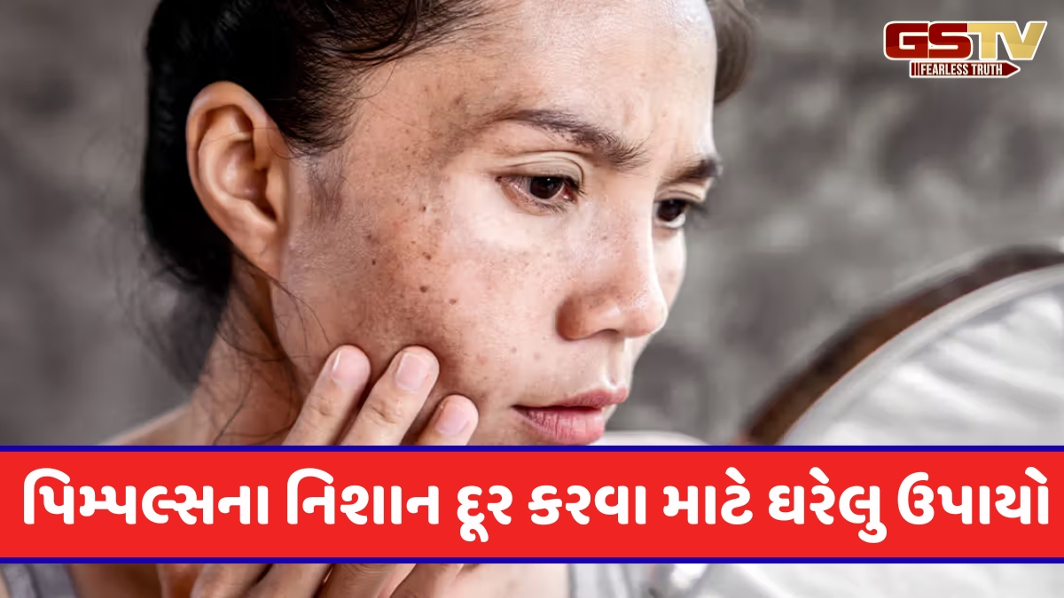 Beauty Tips / ચહેરા પર પિમ્પલ્સના નિશાન પરેશાન કરી રહ્યા છે? તો અપનાવો આ ઘરેલુ ઉપાય