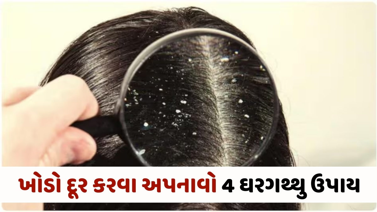 Hair Care Tips: માત્ર મોંઘા શેમ્પૂથી નહીં જાય ખોડો! અપનાવો 4 ઘરગથ્થુ ઉપાય, વાળની સમસ્યા થશે દૂર