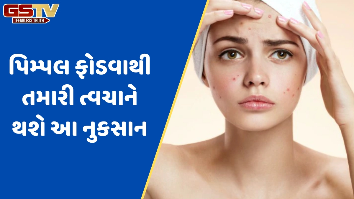 Beauty Tips / પિમ્પલ ફોડવાની આદત બગાડી શકે છે ચહેરાની સુંદરતા, ઇન્ફેકશન અને ડાઘનું પણ રહે છે જોખમ