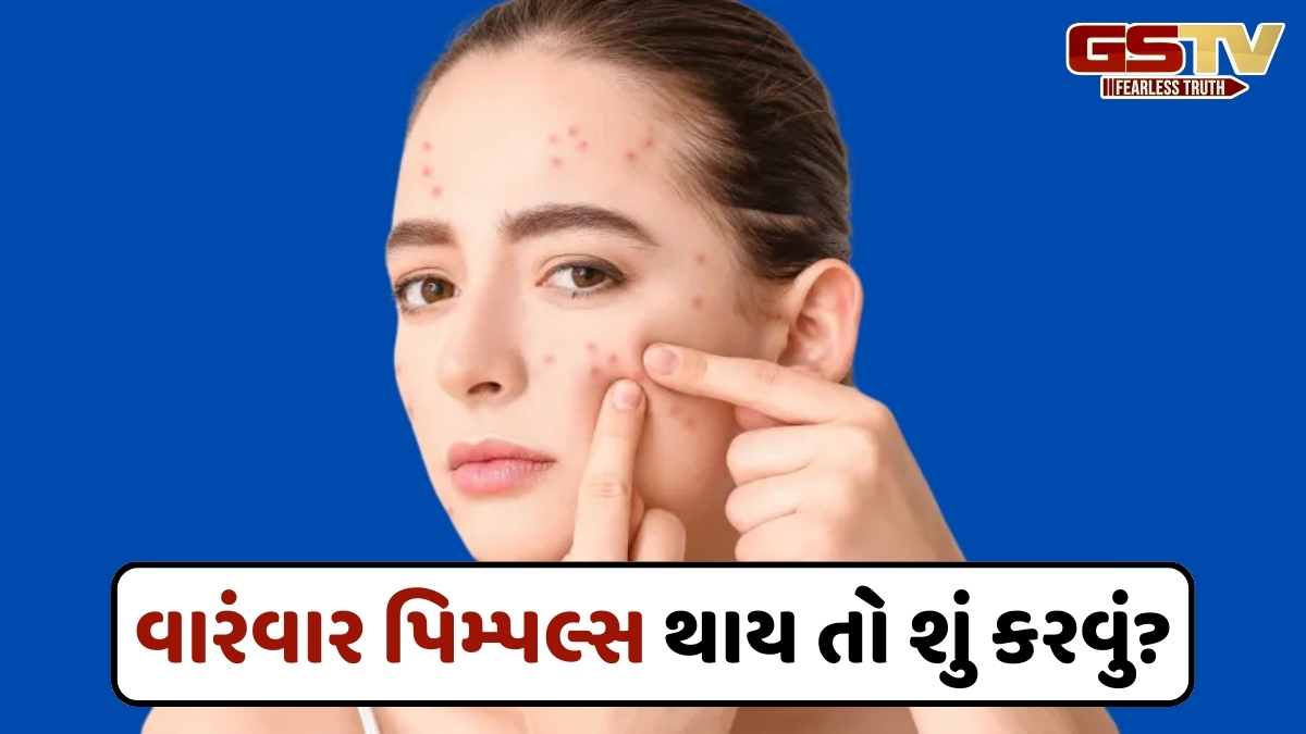 Causes Of Pimples / આ કારણોથી ચહેરા પર આવે છે પિમ્પલ્સ, જાણો તેનાથી બચવાના ઉપાયો