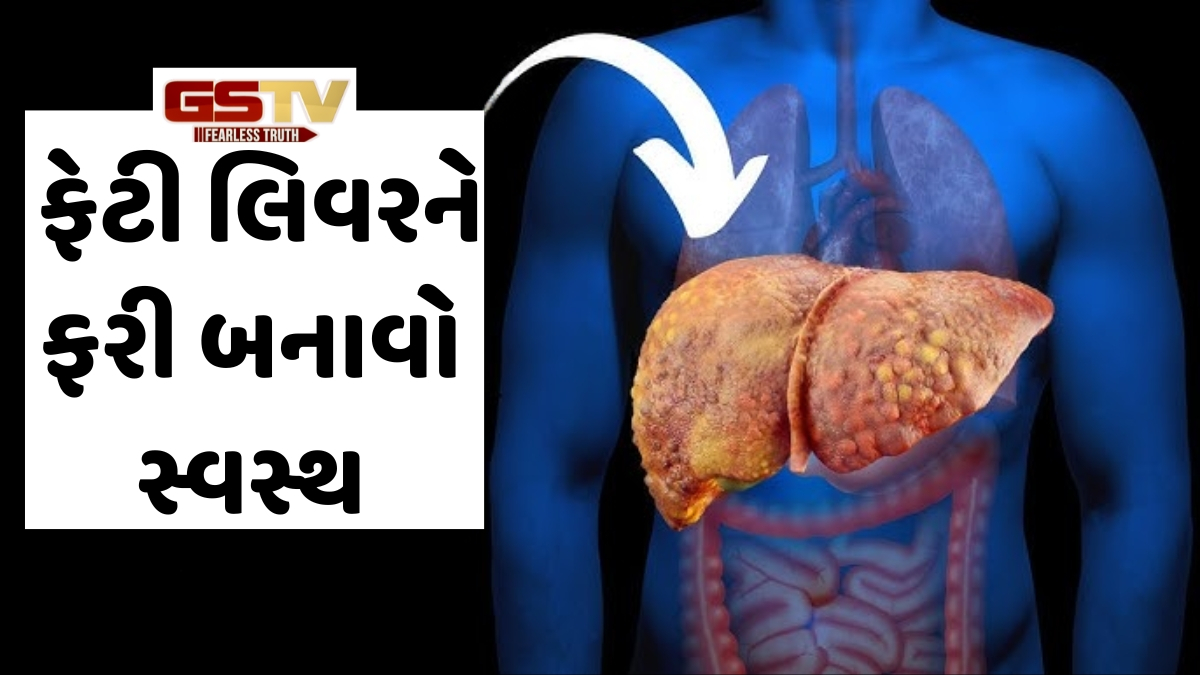 Health: Fatty Liverથી ગભરાશો નહીં! લાઈફસ્ટાઈલમાં કરો આ બદલાવ અને લિવરને ફરી બનાવો સ્વસ્થ