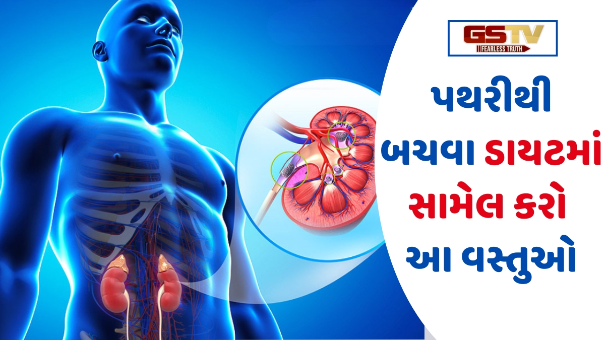 Health: એકવાર નીકળી ગયા પછી પણ ફરીથી થઈ શકે છે પથરી, ડાયટ અને લાઈફસ્ટાઈલમાં કરો આ ફેરફારો