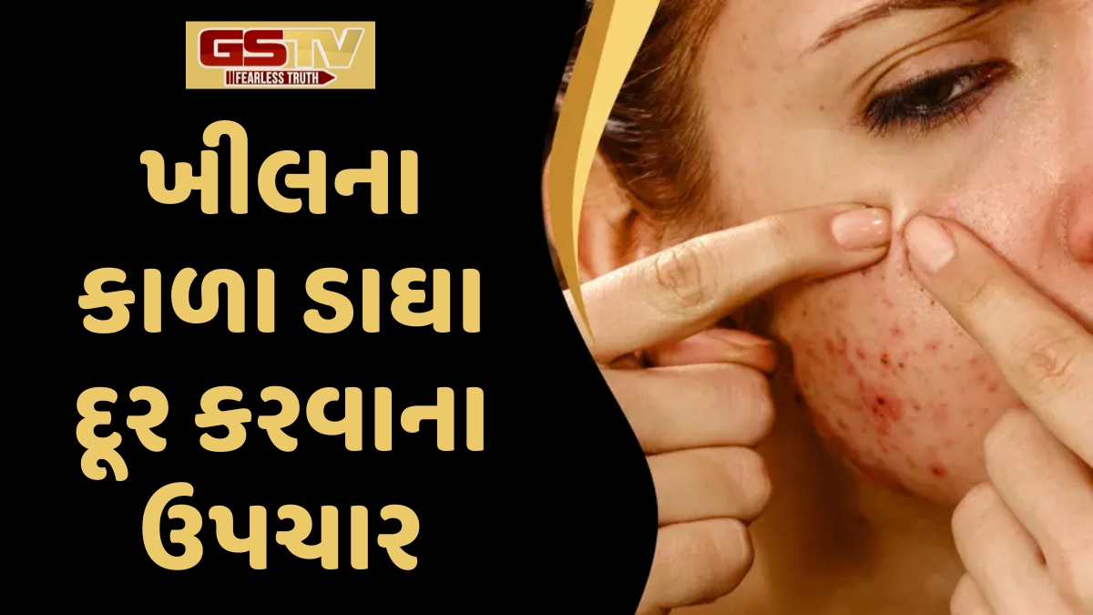 Sahiyar/ સૌંદર્ય સમસ્યા: આ ઉપચાર ચહેરા પરના ખીલના કાળા ડાઘા દૂર કરવામાં કરશે મદદ