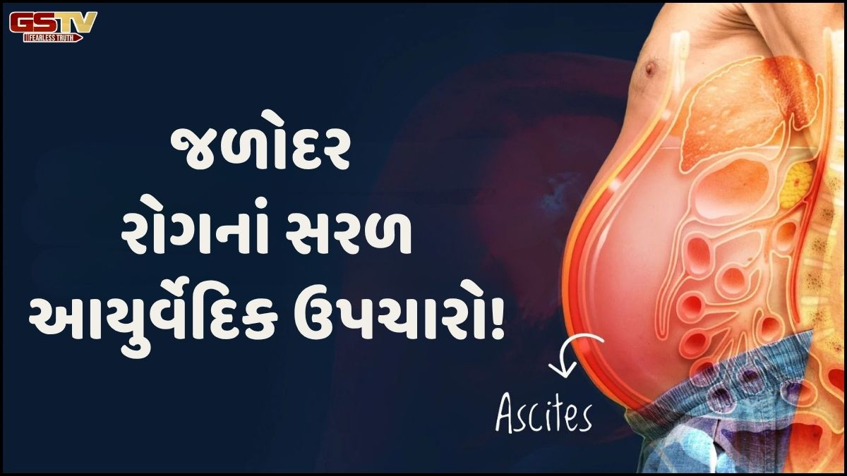 Sahiyar/ જળોદર: તમામ ઉદરરોગોની અંતિમ અવસ્થા, જાણો આયુર્વેદથી થશે સારવાર!