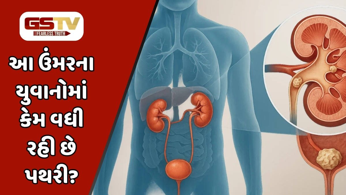 VIDEO : યુવાનોમાં વધતી પથરીની સમસ્યા: જાણો શું છે કારણ અને કેવી રીતે કરશો બચાવ?