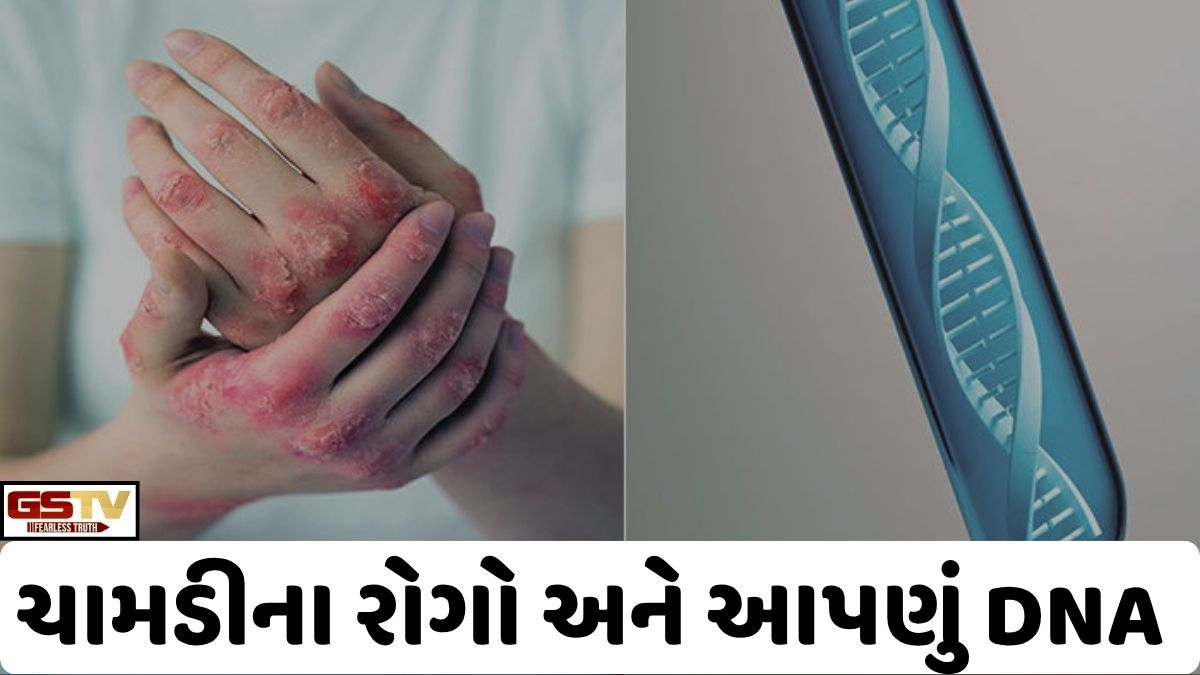 Ravi Purti: ચામડીના આ રોગોનું મુખ્ય કારણ જનીન તત્ત્વોમાં આવેલ DNAની ખામી!