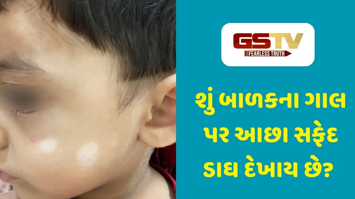 Parenting Tips : મા-બાપની આ ભૂલથી બાળકોના ચહેરા પર પડી જાય છે સફેદ ડાઘ! જાણો બચવાના ખાસ ઉપાયો