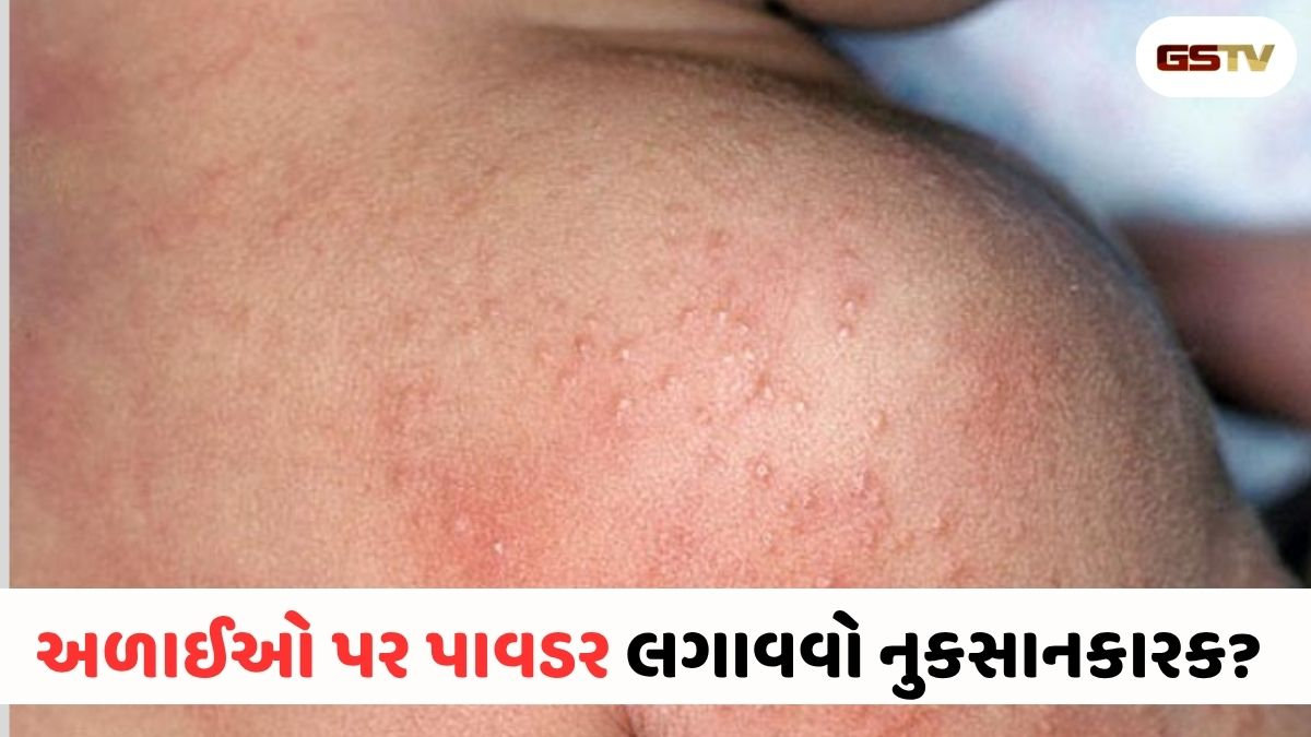VIDEO: Health News/ અળાઈઓ પર પાવડર લગાવતા હોય તો ચેતી જજો: રાહત મેળવવા અપનાવો આ કુદરતી ઉપાયો, જે આપશે તાત્કાલિક ઠંડક