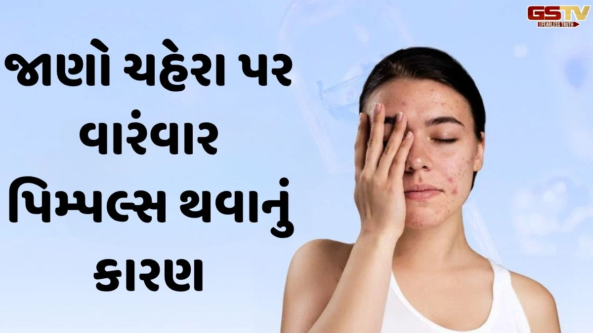 Beauty Tips: પિમ્પલ્સ મુક્ત ત્વચા જોઈતી હોય તો આજથી જ બદલો તમારી આ 5 આદતો, અપનાવો આ ટિપ્સ