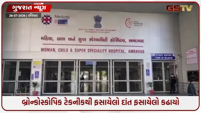 VIDEO: અમદાવાદ સિવિલના તબીબોની કમાલ, દોઢ વર્ષથી દર્દીની શ્વાસનળીમાં ફસાયેલો દાંત માત્ર બે મિનિટમાં કાઢ્યો